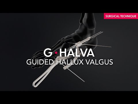 Surgical technique - Guided Hallux Valgus - G·Halva