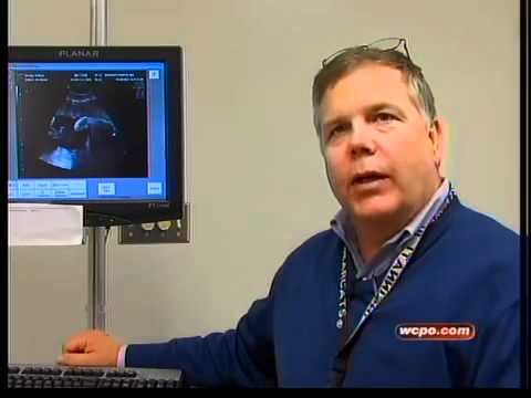 Baby born without arm