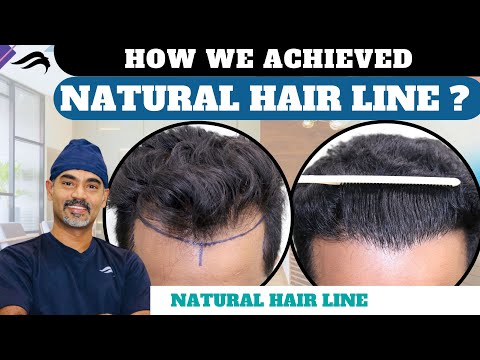 Hair Transplant In Bangalore | Best Surgeon Clinic &...