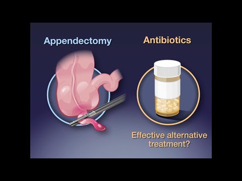 Antibiotika versus Appendektomie bei Appendizitis - NEJM 2020