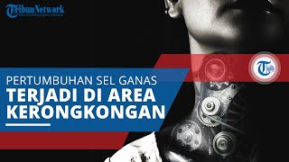 Kanker Esofagus, Pertumbuhan Sel Ganas yang Terjadi di Kerongkongan