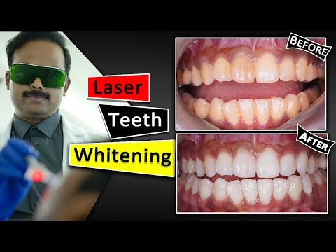Teeth Whitening With Laser | Fastest & Safest way