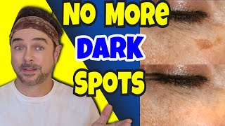 Amazing Dark Skin Spot Remover Under $20 Bucks | Chris Gibson