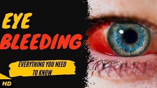 Eye Bleeding: Everything You Need To Know