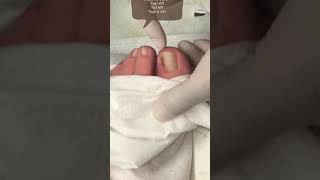 טיפול בציפורן חודרנית ללא כאב,ללא דם,ללא זריקות