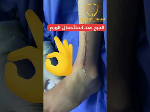 نجاح عملية كحت ورم حميد بالرجل في الاطفال بالمنظار مع دكتور ابراهيم شعراوي