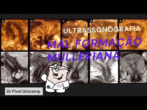 Avaliação das mal formações mullerianas pela ultrassonografia