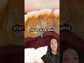 plaque vs tartar on teeth (dental calculus) #shorts