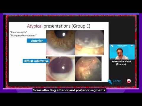WSPOS POST 8, Amblyopia Webinar - "Retinoblastoma. Typical and Atypical Presentations.”