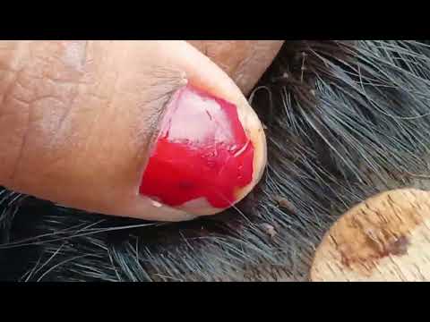 lots of nits#viral#share#pls subscribe#