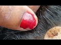 Lots Of Nits Viral Share Pls Subscribe