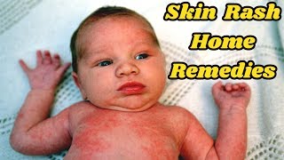 5 Simple Home Remedies For Rash On Your Baby’s Body #NaturalRemedies