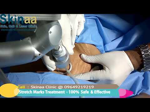 Pregnancy Stretch Marks Treatment by Laser in Jaipur, India – Skinaa Clinic