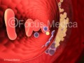 Renovascular Hypertension Atlas Of Hypertension