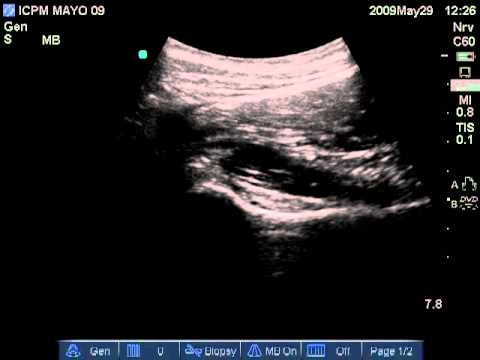 Dolor de garganta cuello hinchadas Dormir si un dolor en el cuello