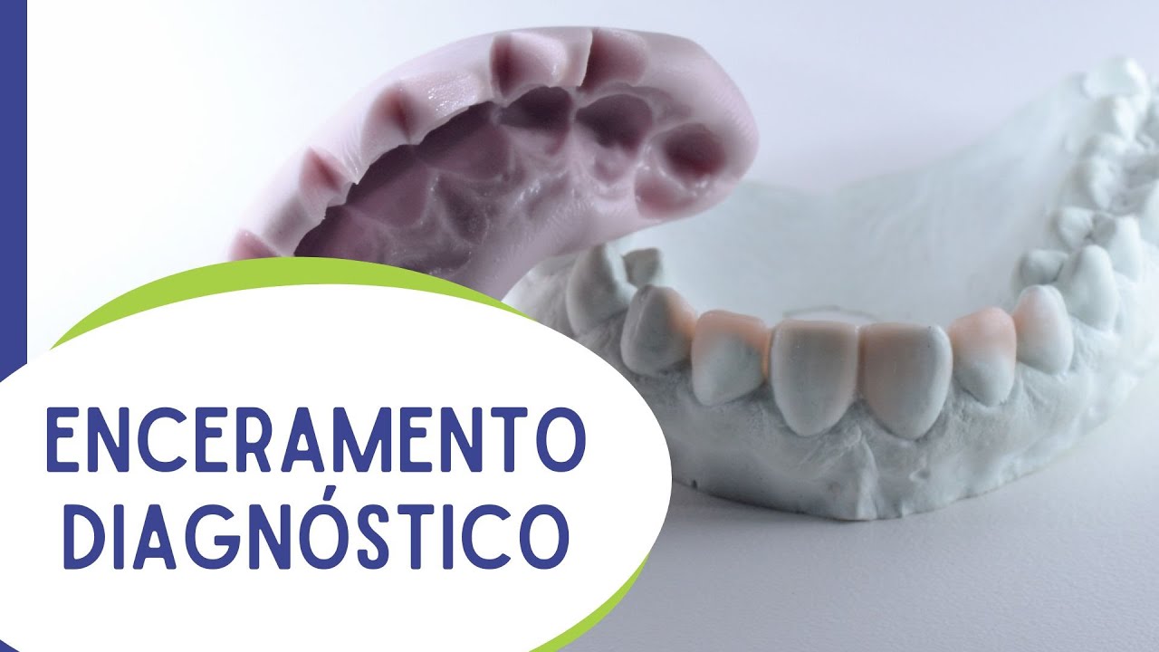 Enceramento diagnóstico para dentes anteriores