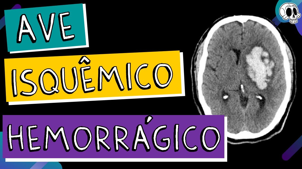 Saiba diferenciar um ACIDENTE VASCULAR ISQUÊMICO x HEMORRÁGICO na TC