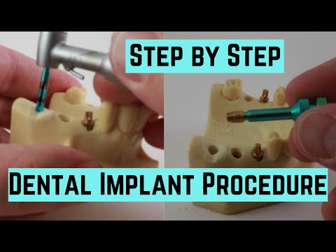 How to place a dental implant step by step in a plastic model, no blood.