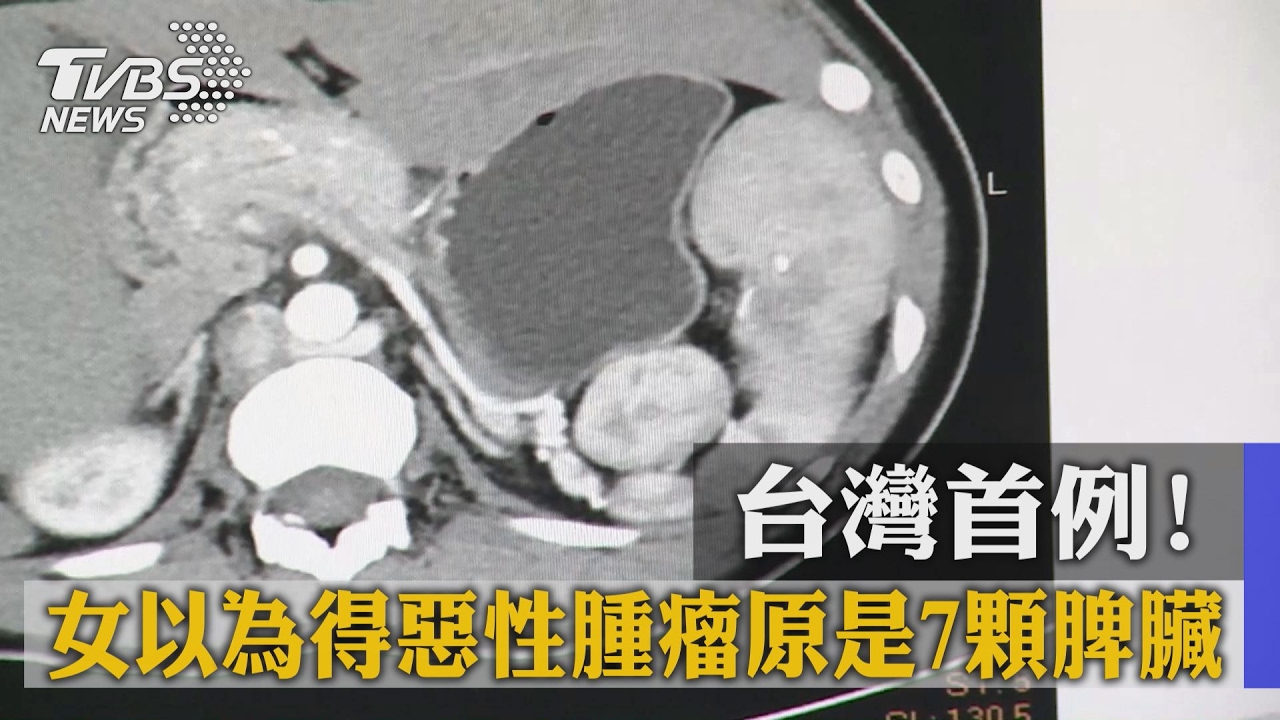 台灣首例!女以為得惡性腫瘤 原來是7顆脾臟