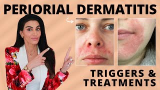 Perioral Dermatitis: Triggers & Treatment Recommendations by a Dermatologist