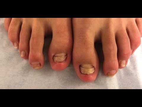 Ciuperca unghiilor și tratamentul pielii