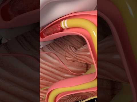 Mechanical Thrombectomy in stroke #medicine #anatomy #science #health #stroke
