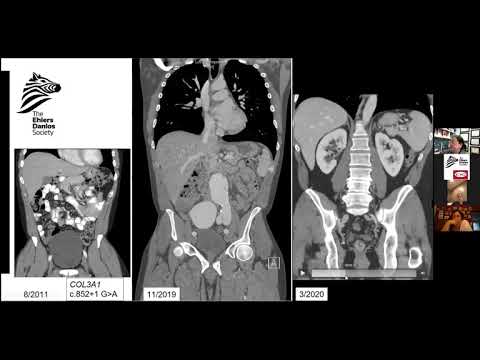 EDS ECHO vEDS (vEDS1), Session 5