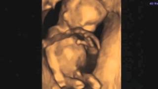 12 Week 4D Ultrasound-Can you Tell the Gender?