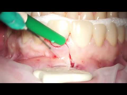 Апикальная микрохирургия центрального резца нижней челюсти