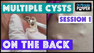 Why so many HUGE BLACKHEADS? Let&#39;s find out the diagnosis! Session 1! Nickname: Momma Squishy