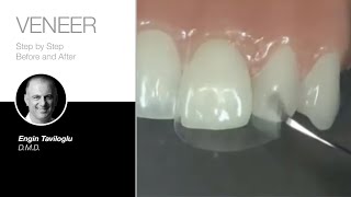 edelweiss VENEER Step by Step Dr Engin Taviloglu 2017