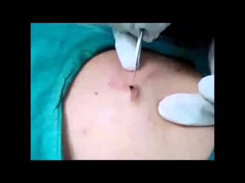Complete Cyst Removal A Technique To Watch
