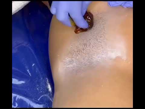 Sugaring armpit