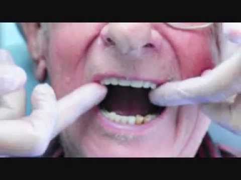 comment appliquer fixodent