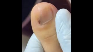 Ep_8168 Foot nails skin removal 👣 สีดำข้างเล็บ..หายไปแล้ว 😄 (clip from Thailand)