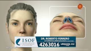 Correcciones estéticas de cirugías de nariz mal hechas   ISOF