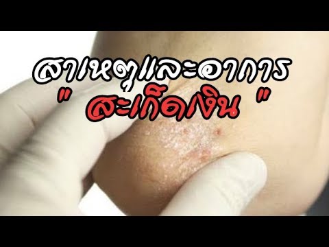 ว่าเด็กไม่ควรอยู่ในโรคสะเก็ดเงิน การรักษา homeopathic กลากในมือ