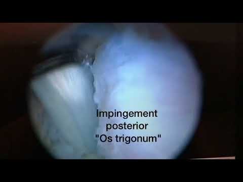 Impingement posterior de tobillo "Os Trigonum"