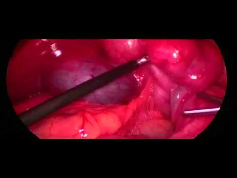 Laparoscopic Ladd's Procedure in a Patient with Malrotation