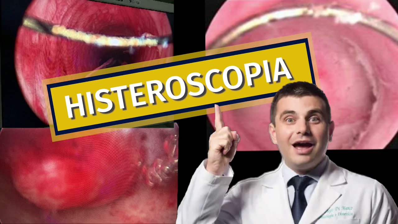 Histeroscopia