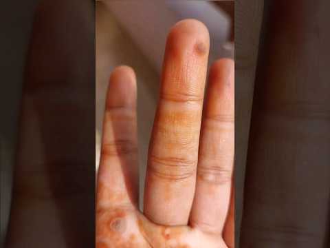 Wart? or corn? #wart #corn #skindoctor #surgery #wartonhand #hand #ccl #devkanya #12.07.23