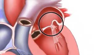 Download lagu Mitral valve regurgitation mp3