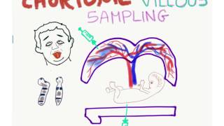 Chorionic Villus Sampling (CVS) Mnemonic