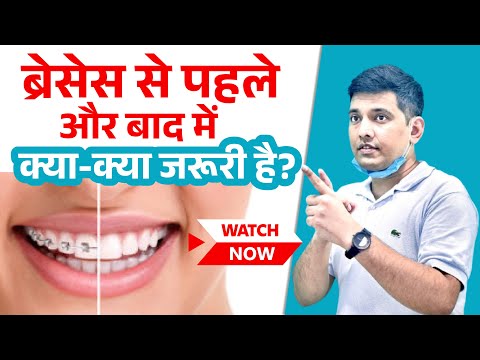 Watch this before getting Braces | Complete Braces care