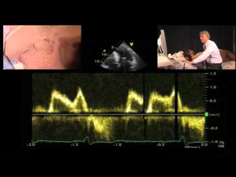 Diastolic Function — A Simple Approach