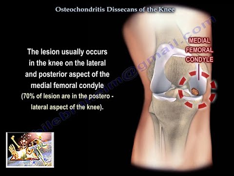 Az Osteochondrosis A Hipertóniát Kíséri. Mi A Legjobb Kenőcs A Nyaki Osteochondrosisra?
