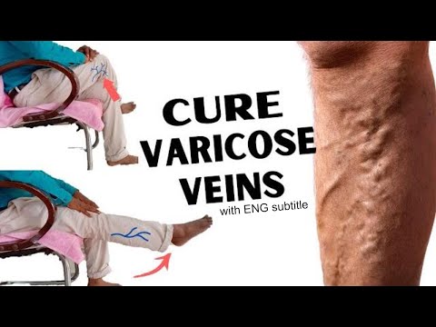 zhivitsa de la varicose recenzii