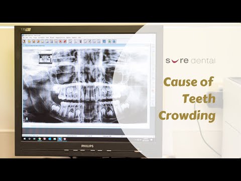 What Causes Teeth Crowding