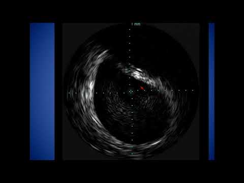 My Worst Venous Complication - Mohsen Sharifi, MD