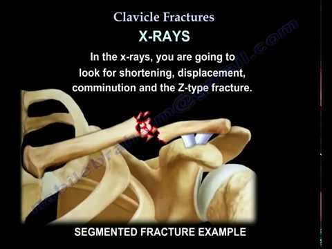 Clavicle Fractures - Everything You Need To Know - Dr. Nabil Ebraheim